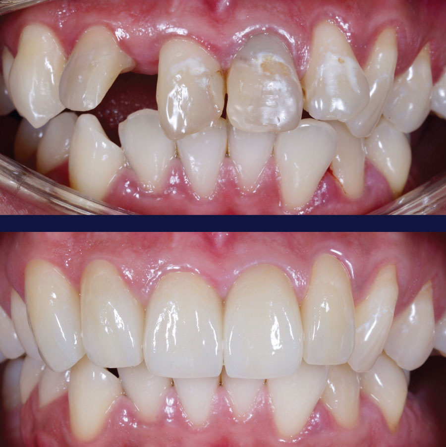 Emergency Dentists in Port Orchard Before and After