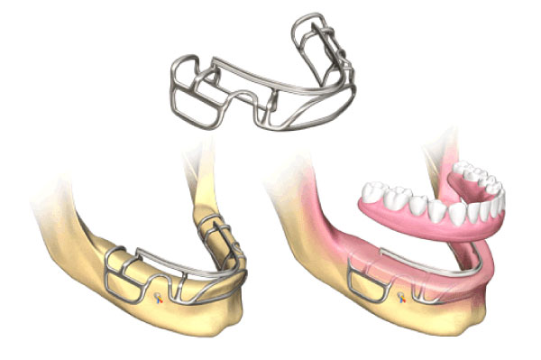 Customized Subperiosteal Dental Implants in Federal Way