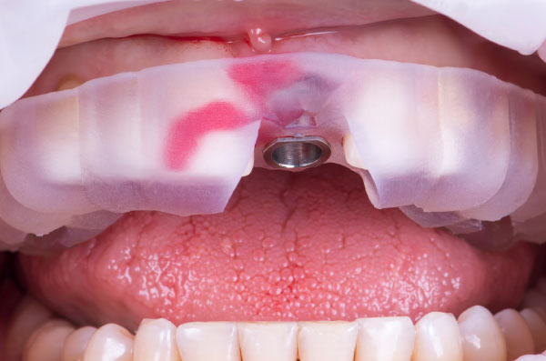 3D Printed Surgical Guide in Federal Way