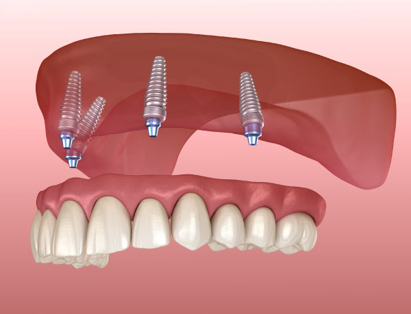 Teeth-In-An-Hour Dental Implants in Federal Way, WA